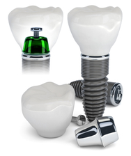 Modelo de implante dental de titanio con corona