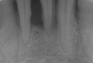 Radiografía periapical del soporte óseo dental