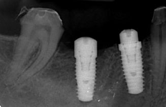 Radiografía de dos implantes dentales osteointegrados
