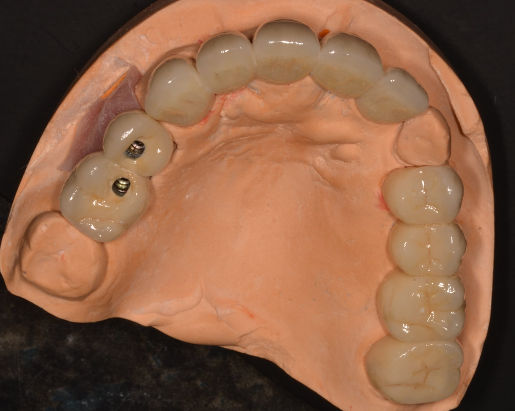 Prótesis dental sobre modelo de trabajo