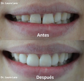 Cierre de espacios dentales, antes y después