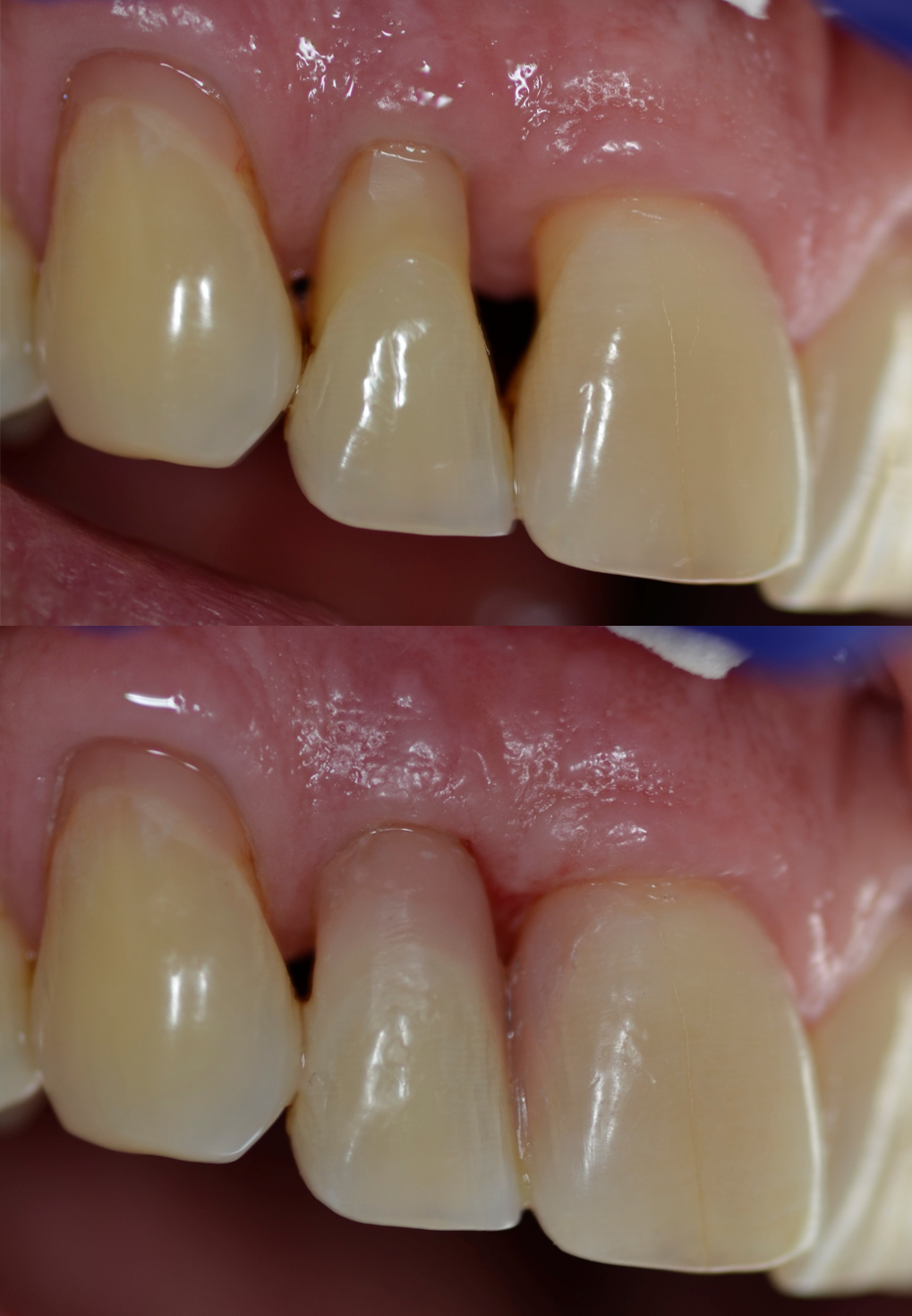 Carillas dentales, detalle antes y después