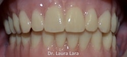 Sonrisa rehabilitada con prótesis total