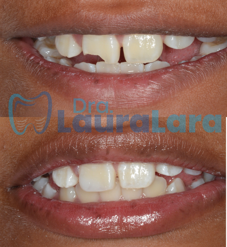 Diseño de sonrisa, antes y después