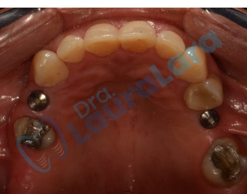Segunda fase quirúrgica de implantes con cicatrizadores