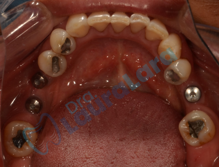 Segunda fase quirúrgica de implantes dentales en maxilar superior