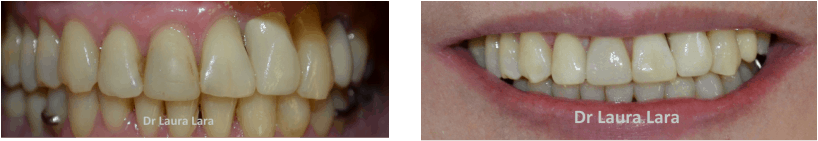 Aclaramiento dental, resultado final