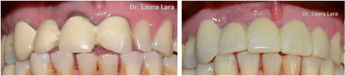 Coronas dentales, situación inicial