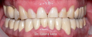 Desgaste dental causado por bruxismo
