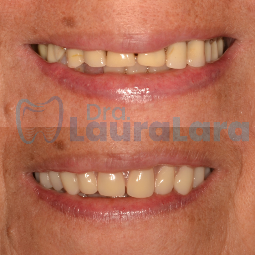 Diseño de sonrisa en dientes desgastados, antes y después